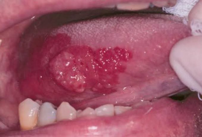 Erythroplakia (Oral Cavity)