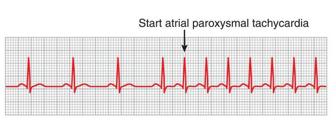 Atrial paroxysmal tachycardia