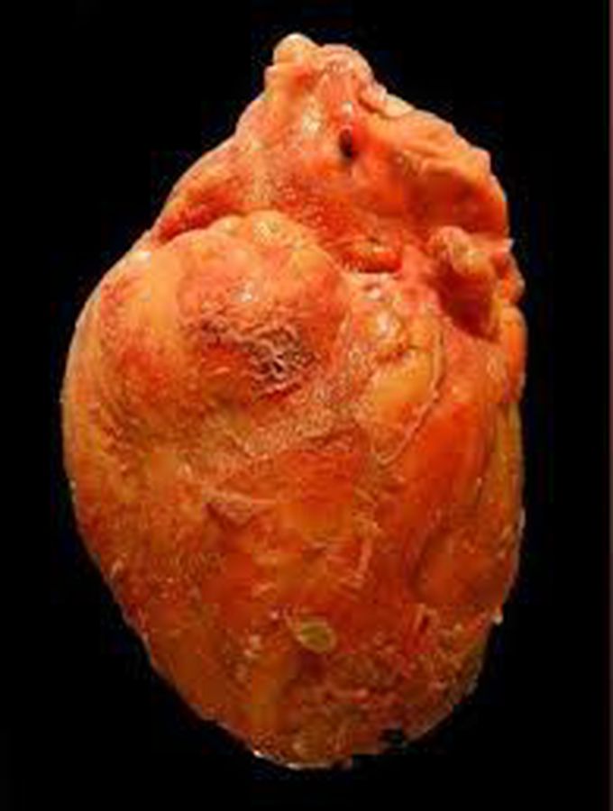 Dressler Syndrome: A post-myocardial infarction syndrome