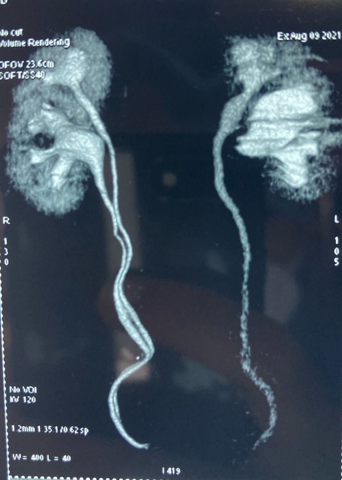 Duplex ureter …follow weigert Meyer rule