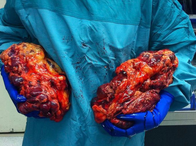 Autosomal dominant polycystic kidney disease