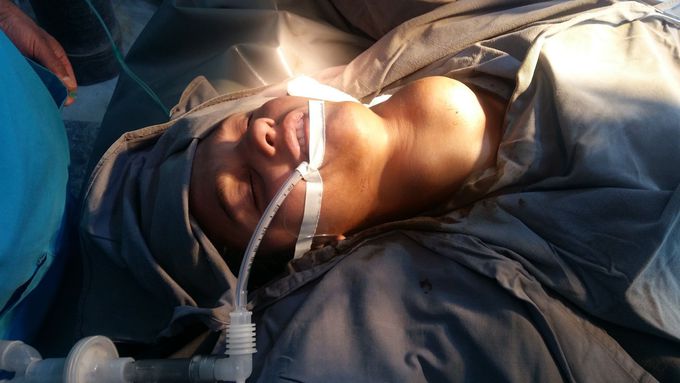 Thyroid mass (goiter )