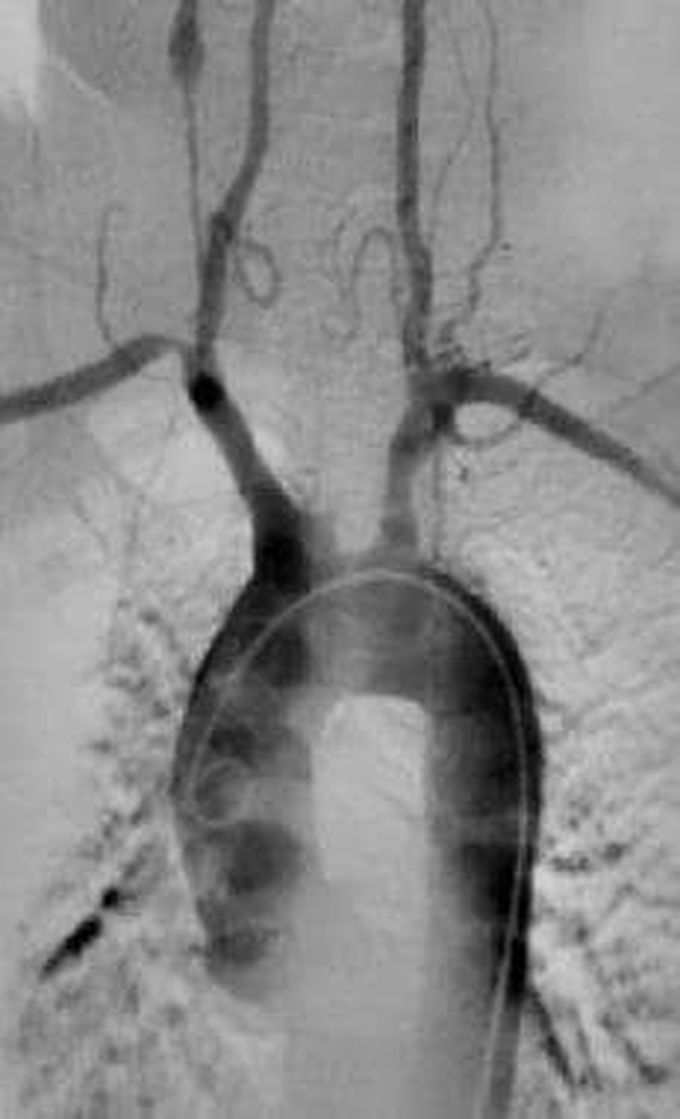 Takayasu Arteritis