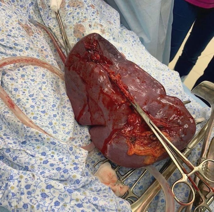 Splenectomy Procedure