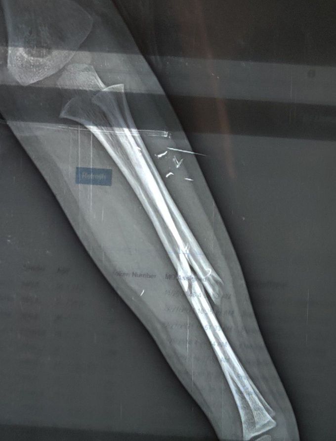 Radius + Ulna Fracture