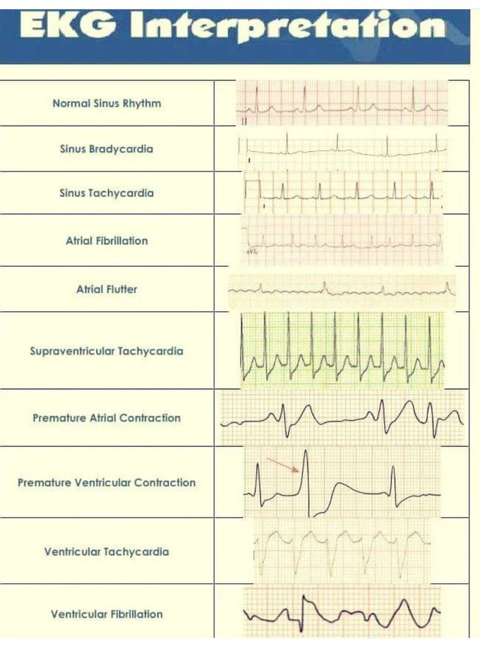 EKG Interpretation