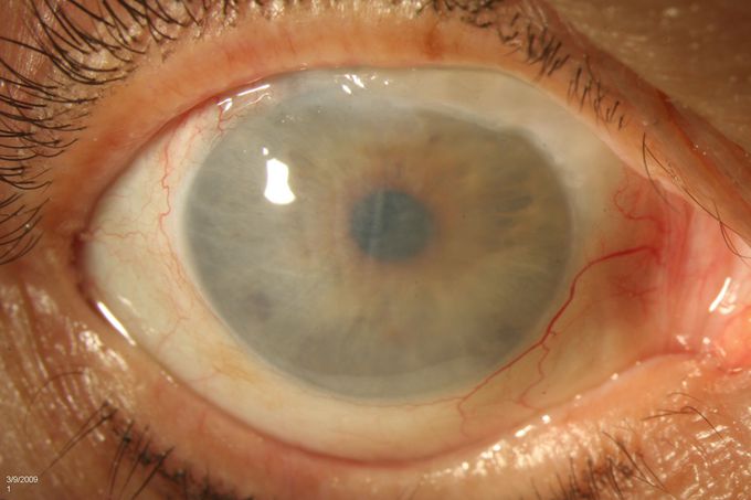 Edema corneal