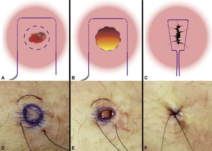 Purse String Sutures