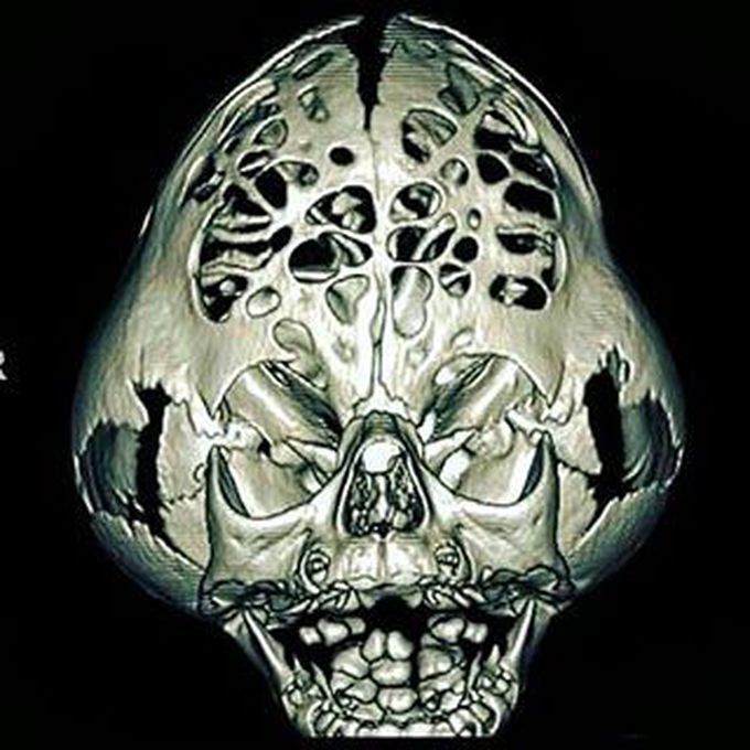 Cloverleaf Skull Syndrome