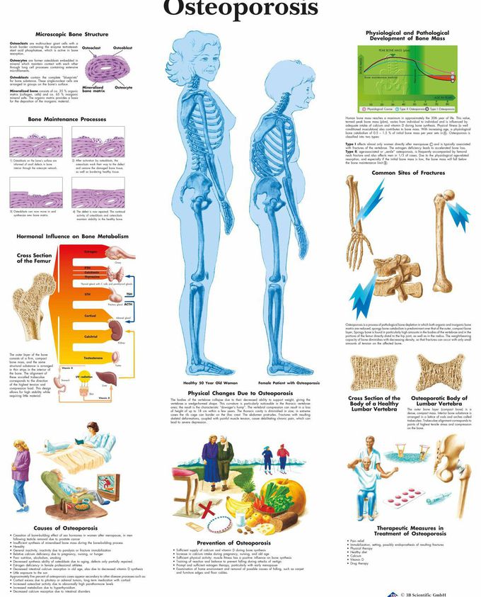 Osteoporosis Medizzy