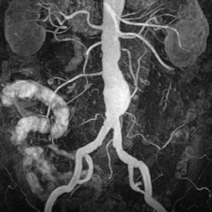 Abdominal aortic aneurysm (enlarged area in the lower part of the aorta) seen by MRI