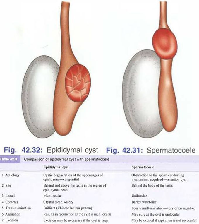 Epididymal Cyst and Spermatocele