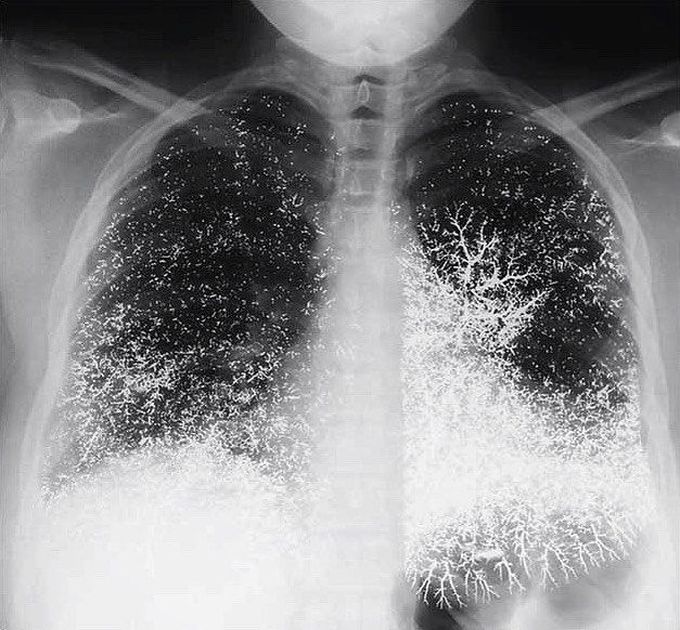 Mercury embolism to the lungs!! 