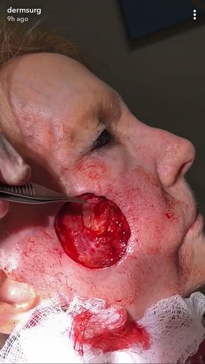MOHS Surgery