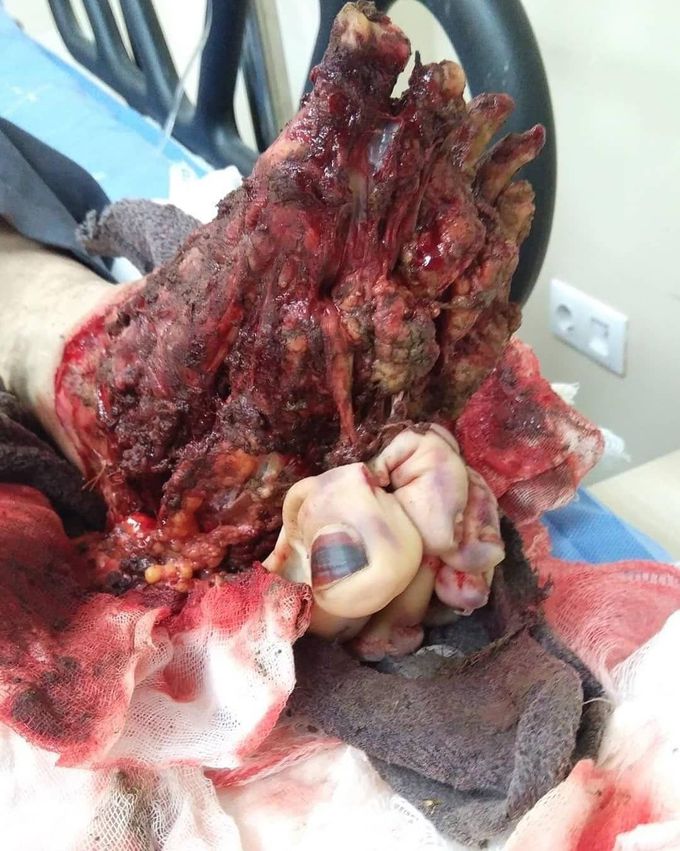 ⚠️ Case of a work realted injury, where a crane malfunctioned, dropping a concrete block on a mans foot, causing a severe crush injury with complete skin avulsion.