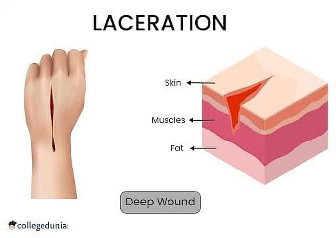 Laceration