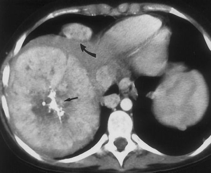 Hepatic Adenoma