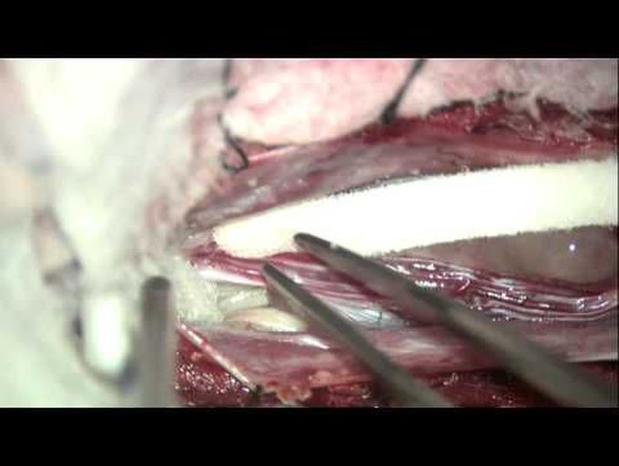 Microsurgical en bloc resection of myxopapillary cauda equina ependymoma