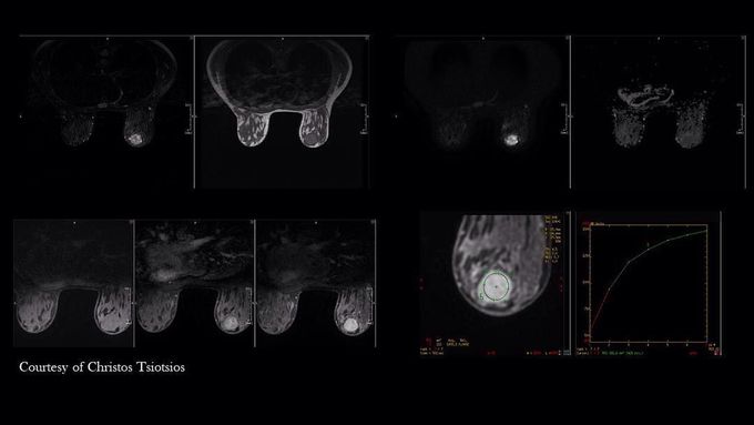 Multiparametric MR Imaging of right breast's fibroadenoma.&nbsp;