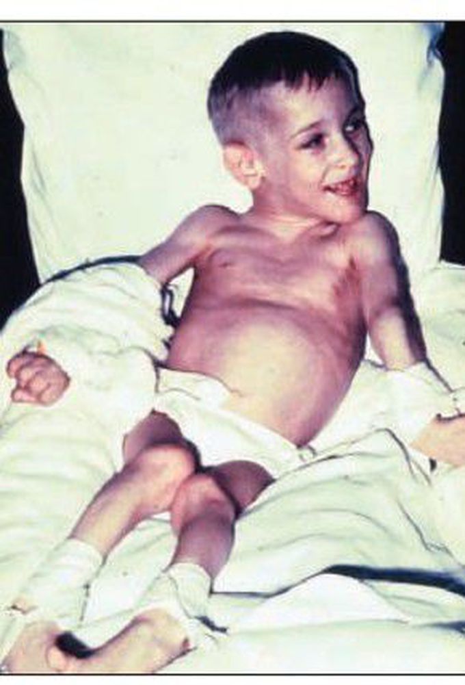 Lesch Nyhan Syndrome