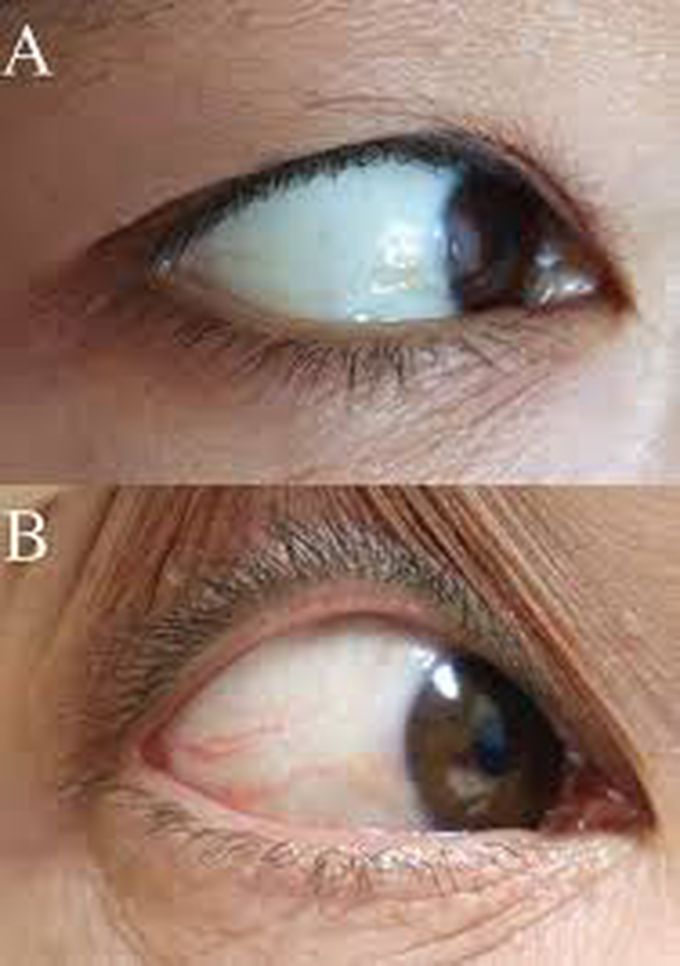 Treatment of blue sclera