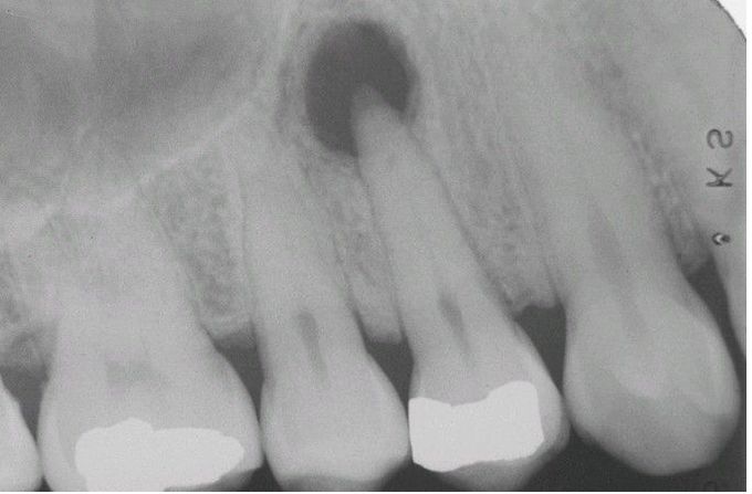 Periapical Granuloma