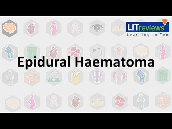Introduction to Epidural Hematoma