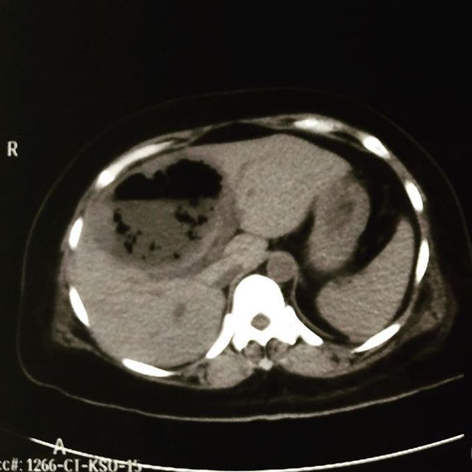 Hepatic abscess - MEDizzy