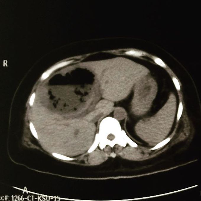 Hepatic abscess