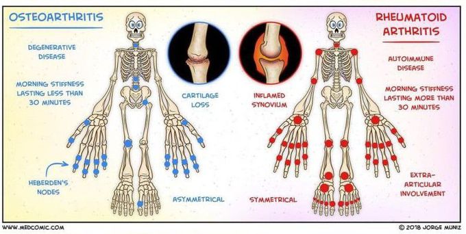 Osteoarthritis (OA) Vs Rheumatoid Arthritis (RA)