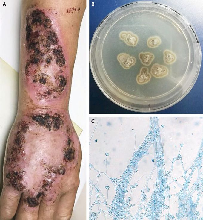 Sporotrichosis