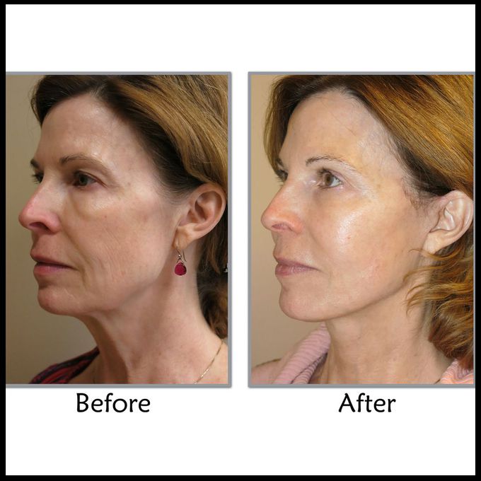 Face Lift Surgery in India