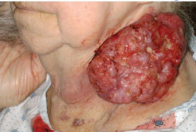 Basal Cell Carcinoma.