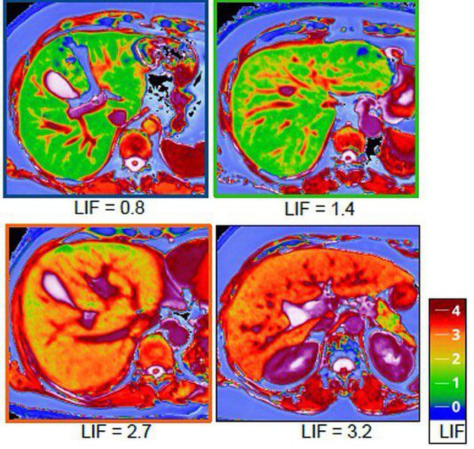 LiverMultiScan