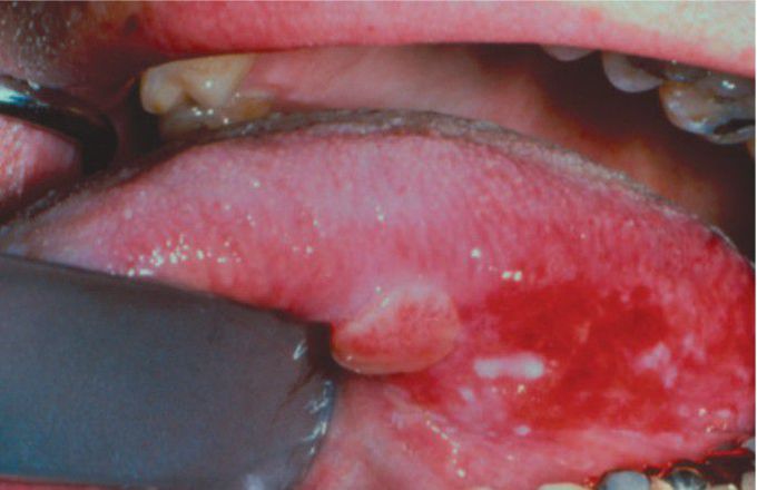 Speckled leukoplakia