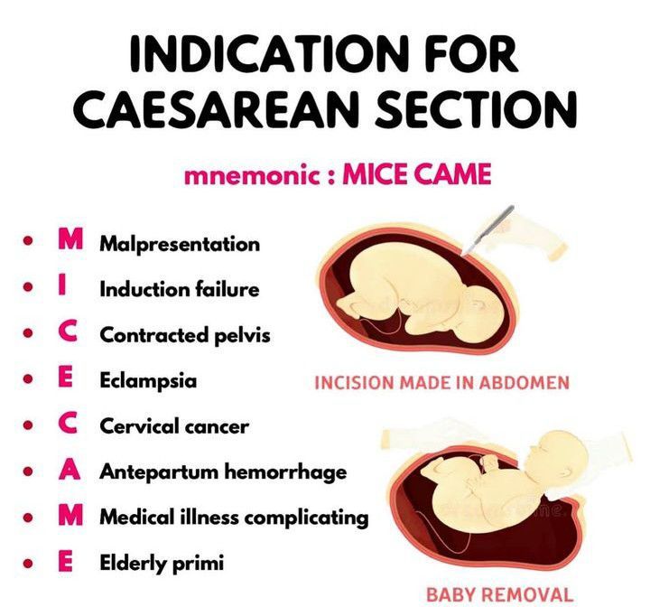 indications for caesarean section in breech presentation