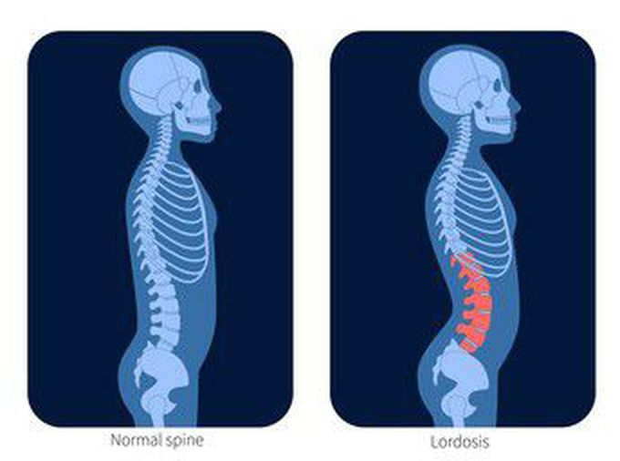 LORDOSIS
