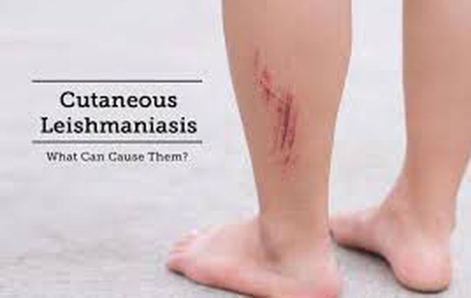 Causes of leishmaniasis