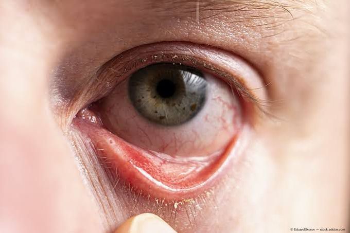 Allergic conjunctivitis