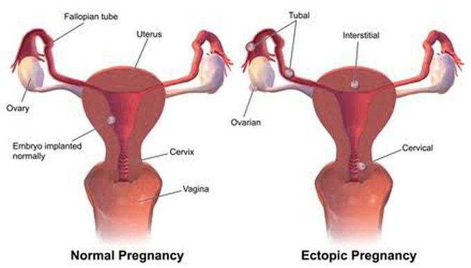 Ectopic pregnancy