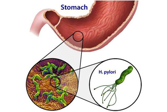 # Gastritis