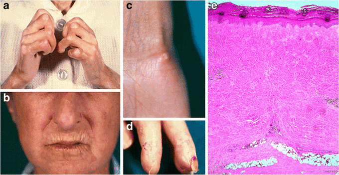 Skin Manifestations of Systemic Sclerosis