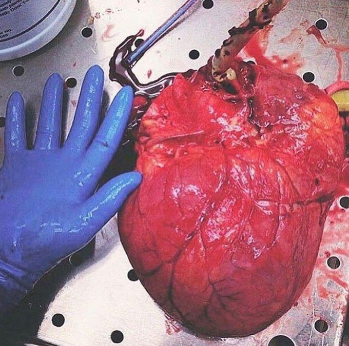 Cardiomegaly case where the size of heart  is larger than the normal size .. Etiology? 