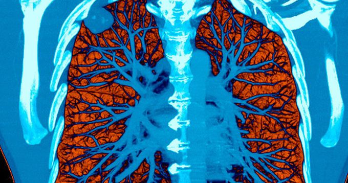 A.I. Took a Test to Detect Lung Cancer. It Got an A.