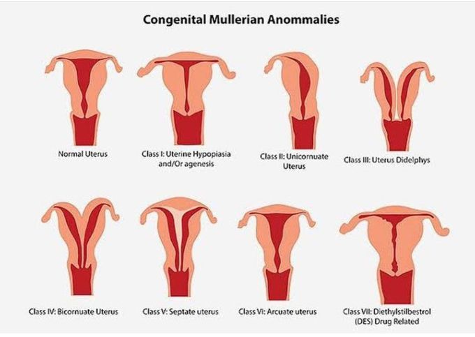 Congenital Mullerian Anomalies