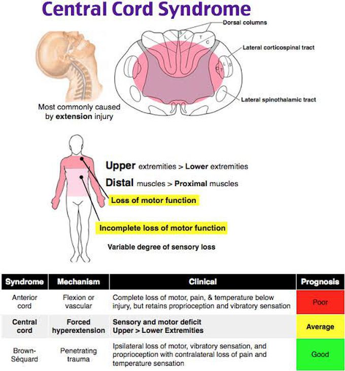 Symptoms of central cord syndrome