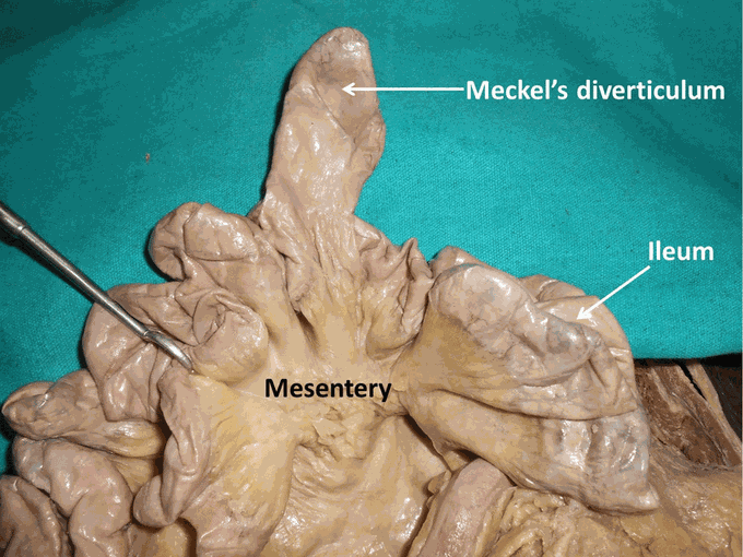 Merkel's diverticulum