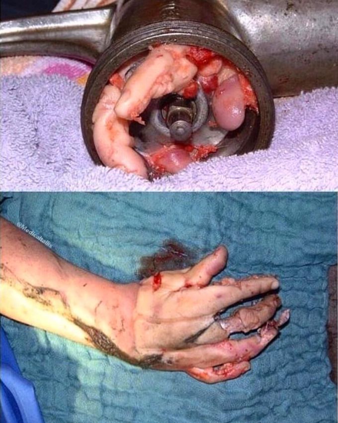 The left hand caught within the meat grinder.