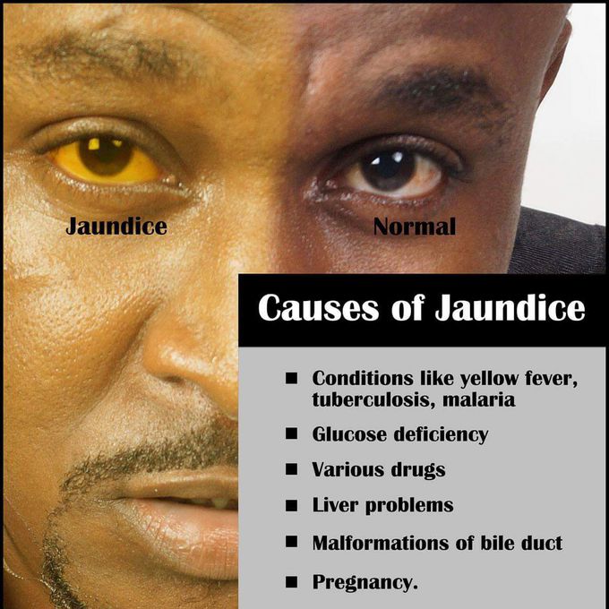 Causes of Jaundice