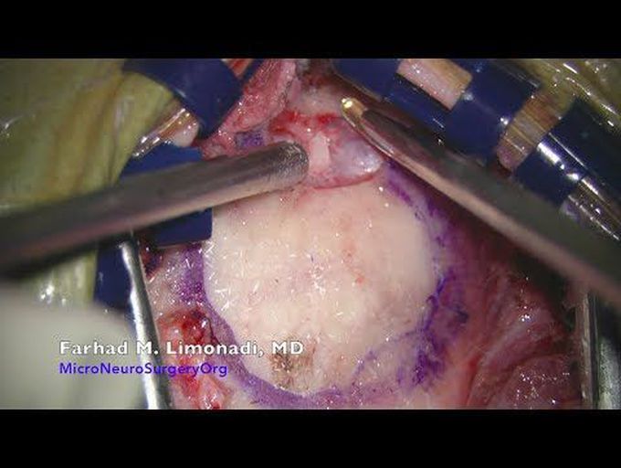 Brain surgery: Surgical resection of a small metastatic brain tumor